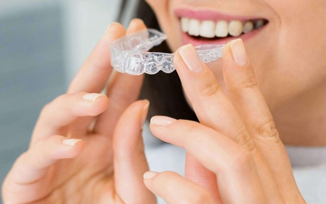 Aligner – de onzichtbare beugel
